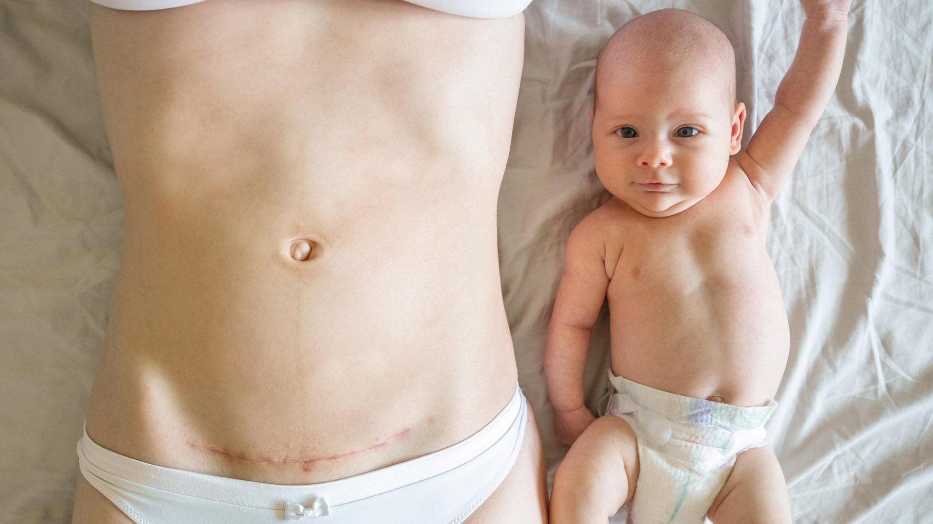 Mama z rana po cesarskim cieciu lezy z noworodkiem